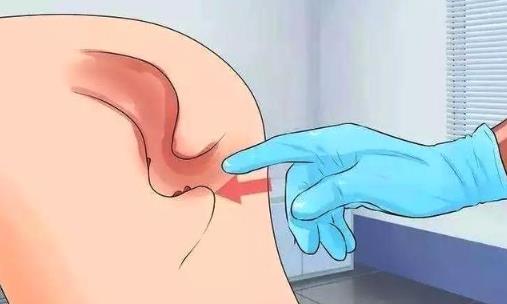 潮湿瘙痒难忍 或许是痔疮或者肛裂的前兆